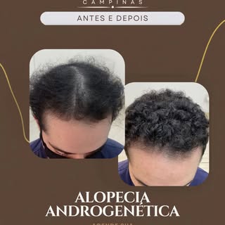 Neste caso o cliente tinha uma grande rarefação gerada por distúrbio hormonal.
Foi necessário orient