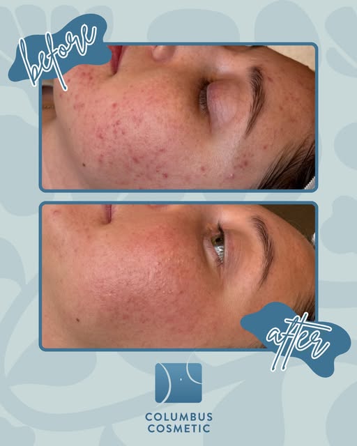 A chemical peel can refresh the appearance of your skin by improving texture, tone, and overall clar