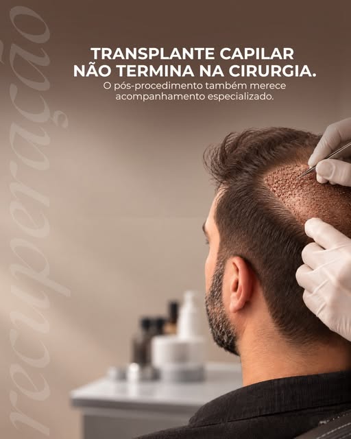 Fazer um transplante capilar é apenas uma etapa do processo.

Depois do procedimento, o couro cabelu