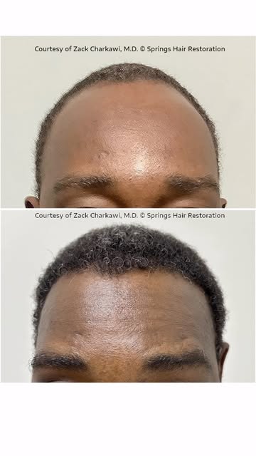 Will a hair transplant 
look natural with my 
hair texture?