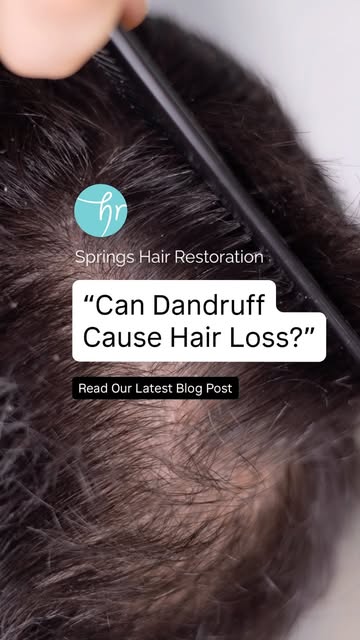 Dandruff itself doesn’t directly cause hair loss, but it can contribute to temporary shedding.

How?