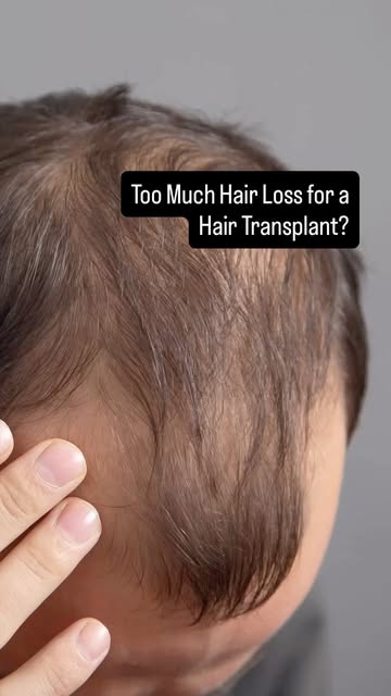 Experience excellence in hair transplantation with Dr. Zack Charkawi.

✅ One of only 270 surgeons ce