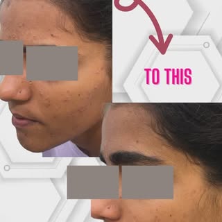 ✨ Real Results, Real Confidence!✨ 
 
At Dermadex Clinic, we believe in delivering real solutions, no
