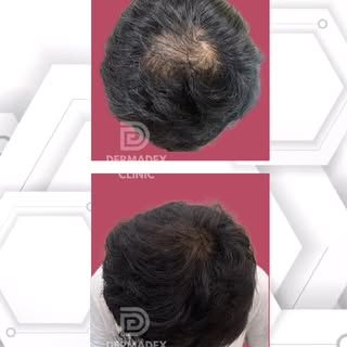 🌟 GFC Therapy: Real Results, No Filters! 🌟 

Watch this amazing before-and-after transformation of