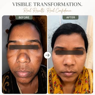 Real Skin Progress. Real Confidence.

Melasma can be stubborn, but with the right diagnosis, medical