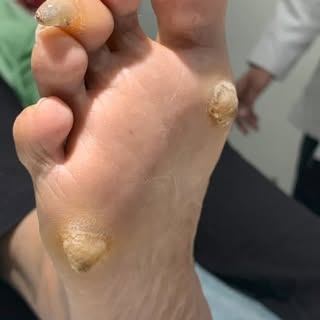 Pain while walking? 👣😣
 That rough, hard skin might be a callus — and ignoring it only makes it wo