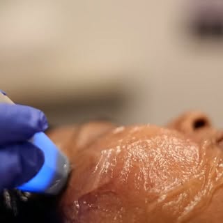 Radio frequency treatment 

#skinaaclinic #skinaa #viral #treatment #skintreatment