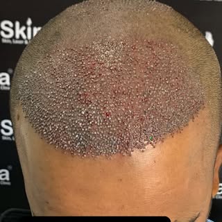 Invest in your hairs, it is the crown 👑 you never take off 

#skinaaclinic #viral #skintreatment #t
