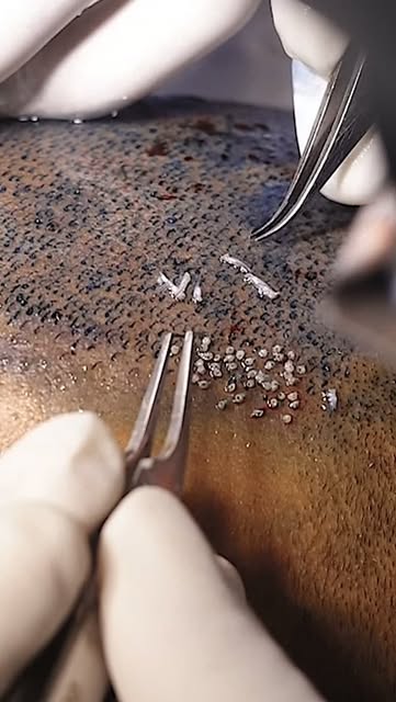 13years issue solved in a day 

#skinaaclinic #viral #skincare #skintreatment
