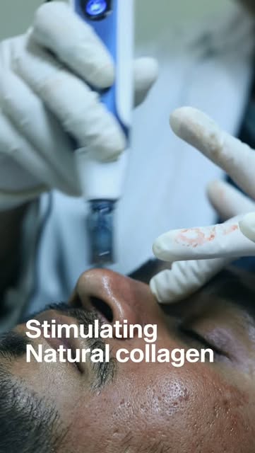 Stimulating Natural Collagen through micro-needling treatment @skinaa.clinic

#skin #hair #beauty #v
