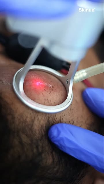 CO2 laser for treating scars @skinaa.clinic

#skin #hair #viral #skinhealth #shorts