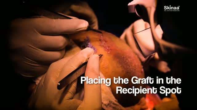 Placing the Graft in the Recipient spot @skinaa.clinic 
@skinaa_hair_transplant
#skinaa #viral #skin