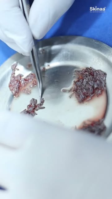 Micro- tweezers separating the donor grafts @skinaa.clinic 

#skinaaclinic #viral #skinaa #shorts