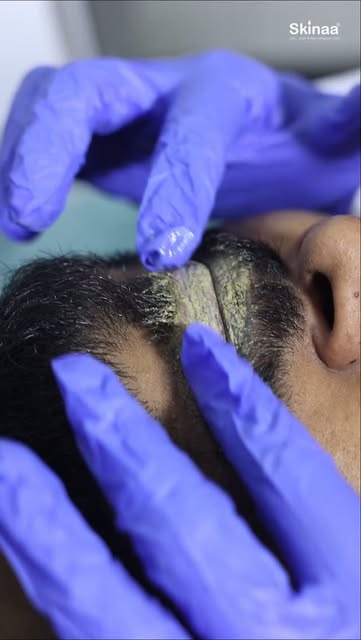 Carbon laser for reducing lip pigmentation #treatment #skinaaclinic 

#viral #skincare