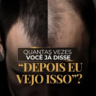 Muitos homens deixam pra depois.
E com o cabelo, não é diferente.
Vão adiando…
Esperando melhorar so