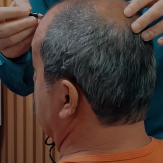 📍A marcação é uma das etapas mais importantes do transplante capilar.
É quando eu mostro exatamente