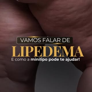 No tratamento do lipedema com minilipolaser, a gordura doente é aspirada com precisão e menos trauma
