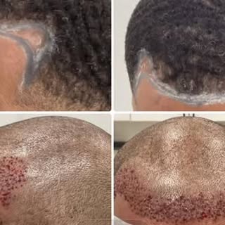 Still hiding your hairline? 🤔
This is your sign to stop waiting and start transforming.

Real clien