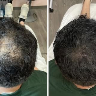 🔍 Case closed. The bald patch had a name.

His scalp told a story most doctors missed. We ran the i
