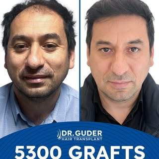Hair transplantation is not just a transformation; it is a scientific journey that must be planned i