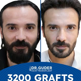 The Art of a Natural Hairline: 3200 Grafts Transformation 🖋️✨

True hair restoration is more than j