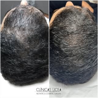 Mira el cambio que ha pegado nuestro paciente en cuestión de 3 meses 🤩

Con unas pocas sesiones de 
