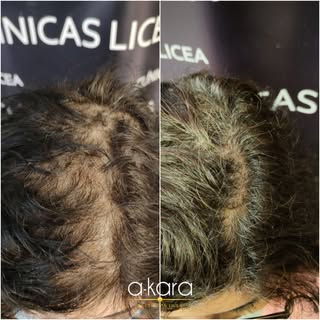 Recuperar el pelo en nuestras clínicas ¡Si es posible! 🤩

👉🏼Aquí les dejamos este antes y despúes