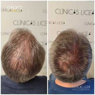 Mira el cambio que ha pegado nuestro paciente 🤩
Con unas pocas sesiones de nuestro tratamiento comb