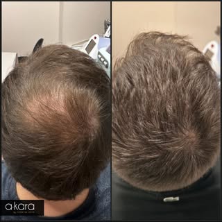 Recuperar el pelo en Akara🤩 ¡Si es posible!

Aquí les dejamos este antes y despúes.
Increíble resul