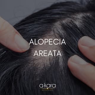 ¿Conoces este tipo de Alopecia?🤔

👉La alopecia areata es una de las causas más comunes de la pérdi