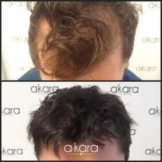 Recuperar el pelo en Akara🤩 ¡Si es posible!

Otro caso de antes y despues increible 🙌
Nuestro paci