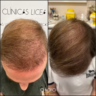 👉Potencia los resultados de tu injerto capilar con nuestra avanzada terapia de carboxiterapia y der