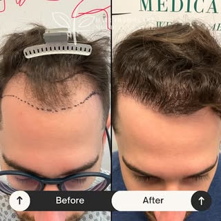 Real Results. Real Confidence. 

Your new look starts at Hair Transplant Medical Centre. Contact Us 