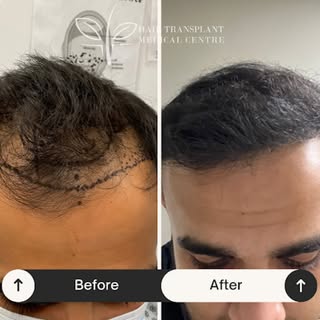 Before ➡️ After: Real results, real confidence.
Book your free scalp analysis today—contact us to st