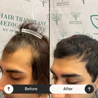 From thinning to thriving! 👏

This incredible before-and-after shows what expert hands and advanced