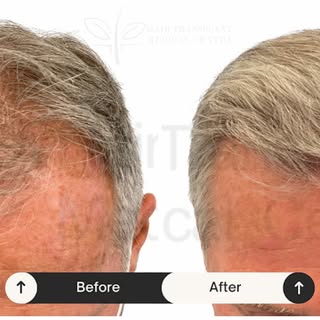Before ➡️ After: Real results, real confidence.
Book your free scalp analysis today—contact us to st