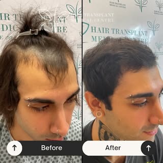 Happy clients, happy business! Looking for the best hair transplant clinic in Ontario? Let us help. 