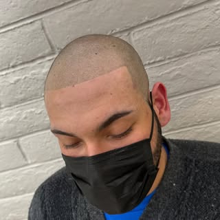 A hairline can change more than just your appearance, it can change your confidence! 

From no hairl