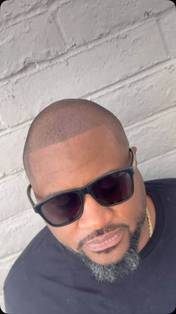 Crisp. Clean. Confidence restored. 🔥

A restored hairline can completely change the game. Scalp Mic
