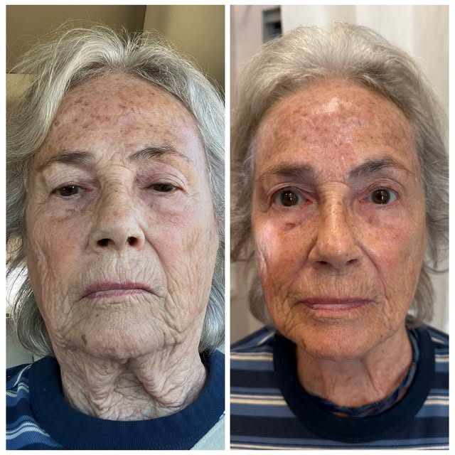 First session BioRepeel + Procell Microchanneling = Unbelievable Results