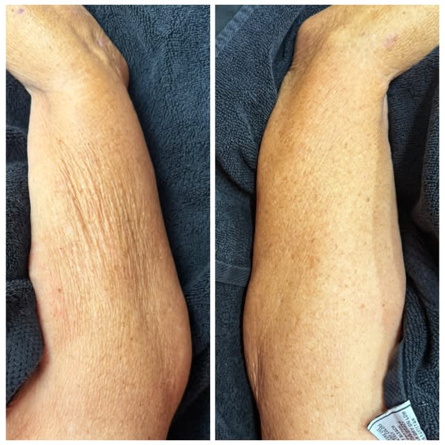 First session Procell Microchanneling upper arms on this 82 year old beauty. Before and after. 🧡🔥�