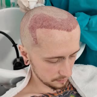 FUE allows for precise, strategic graft placement while giving patients the flexibility to wear thei