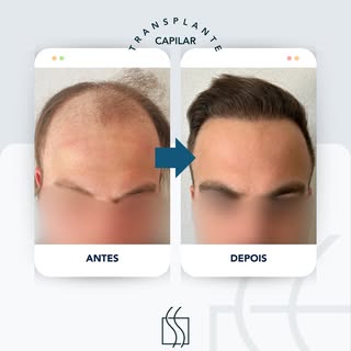 Não deixe que a calvície seja um problema na sua vida!

Aqui na Telles, o Transplante Capilar é real