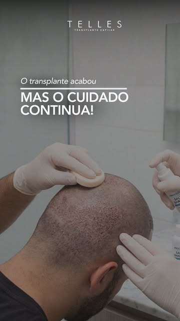 Depois de um transplante capilar, os cuidados não terminam quando o paciente sai da clínica.
Existe 