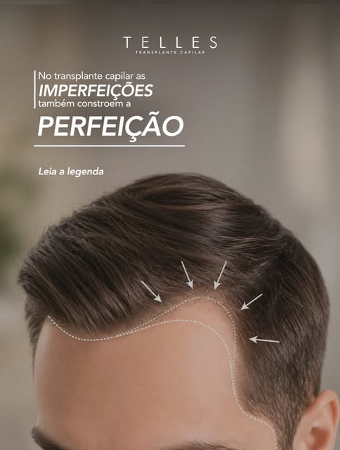 Quando observamos uma linha capilar natural, dificilmente encontramos fios perfeitamente alinhados, 