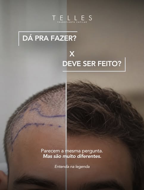 No transplante capilar, uma das diferenças mais importantes está entre aquilo que pode ser feito e a