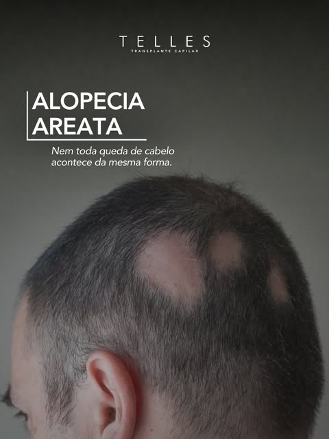Nem toda queda de cabelo é calvície. E nem toda área sem cabelo deve ser tratada da mesma maneira.

