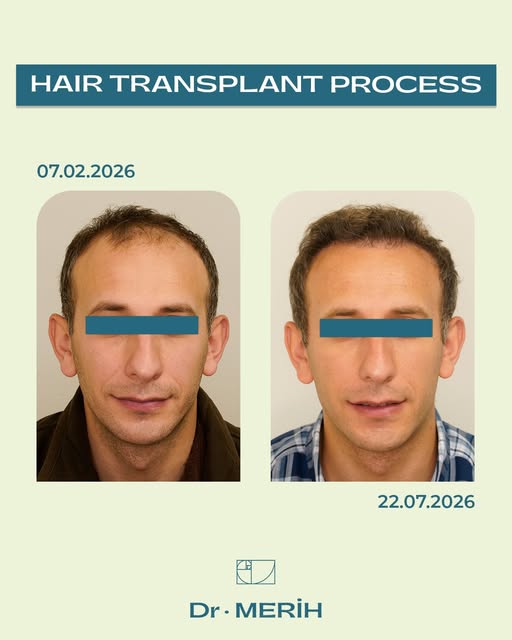 The natural growth process following a hair transplant requires patience and regular follow-up. 🌿


