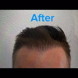 Las Vegas Hair Restoration 
Dr. F. Carullo 
#hairtransplant