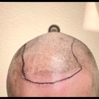 #hairtransplant